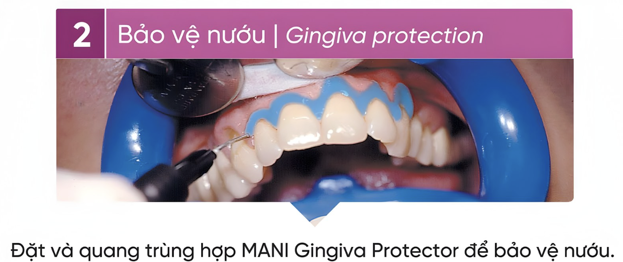 Quy trình tẩy trắng răng🌱không cần chiếu đèn Mani Bleach&rsquo;n Shine🌱NHA KHOA MALL🌱